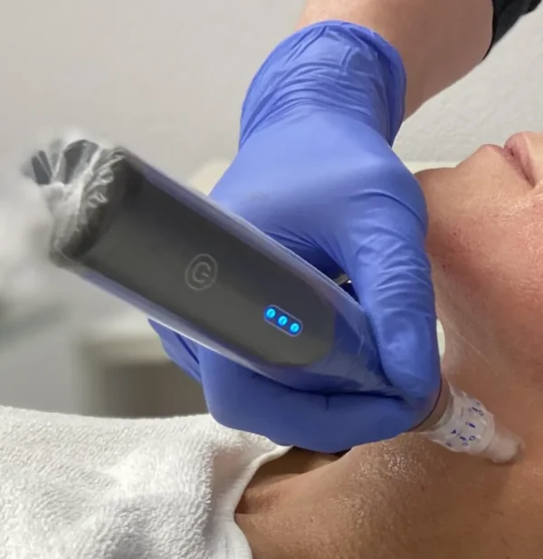 Microneedling met de SkinPen bij Velvet Clinics